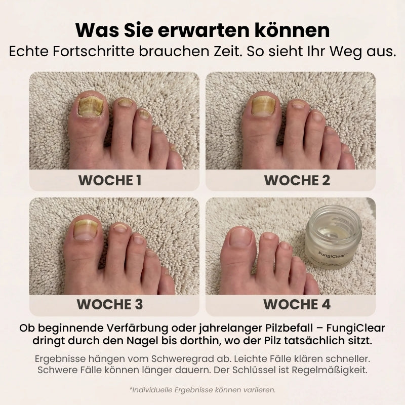 FungiClear™ | Behandlungscreme gegen Nagelpilz