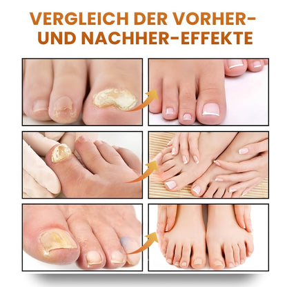 CuraNail™ |  Antipilz-Spray