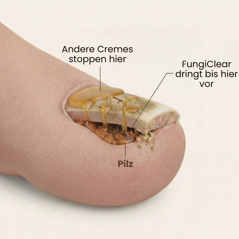 FungiClear™ | Behandlungscreme gegen Nagelpilz