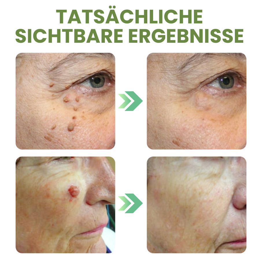 HydroSeal™ Hydrocolloid Patches